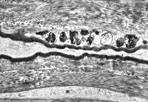 F,25y. | metachromatic leukodystrophy - n. suralis